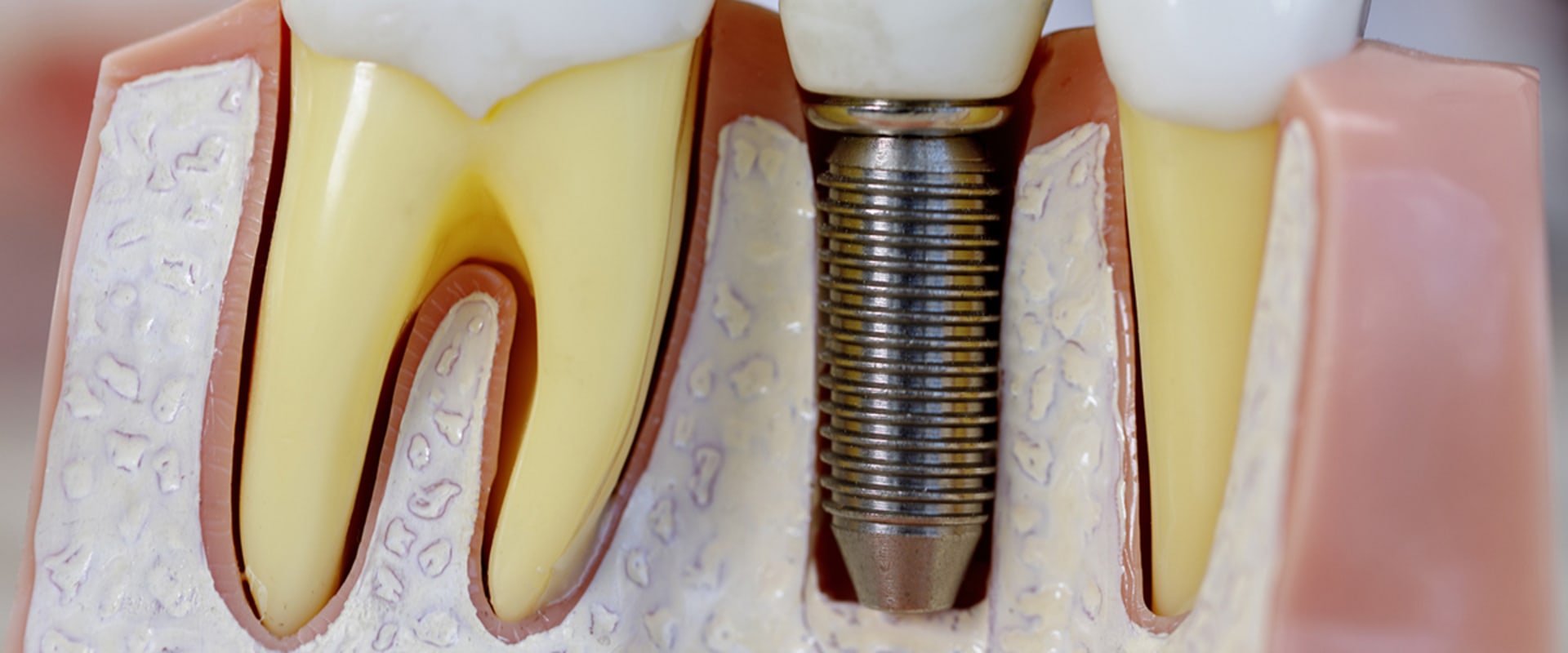 Why Titanium is the Ideal Choice for Dental Implants