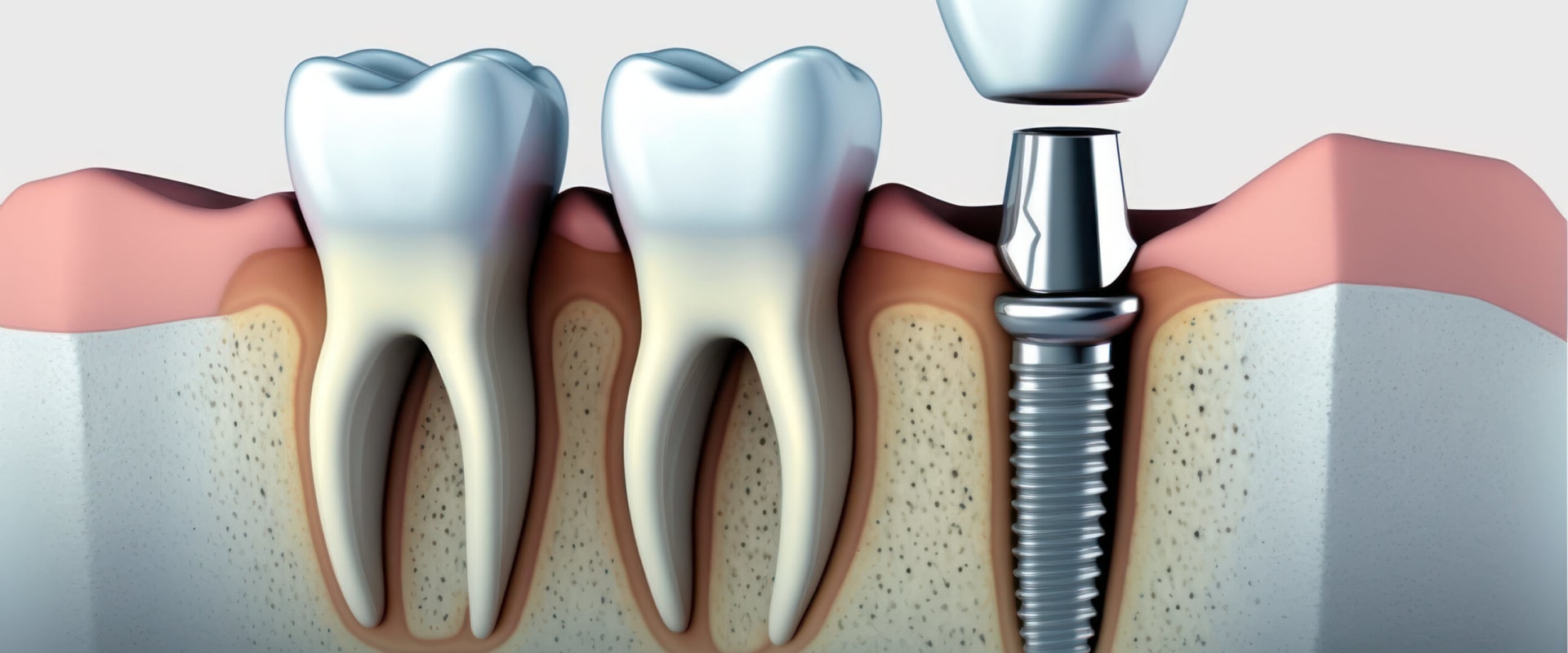 The Complete Guide to Placing Endosteal Implants: A Comprehensive Overview