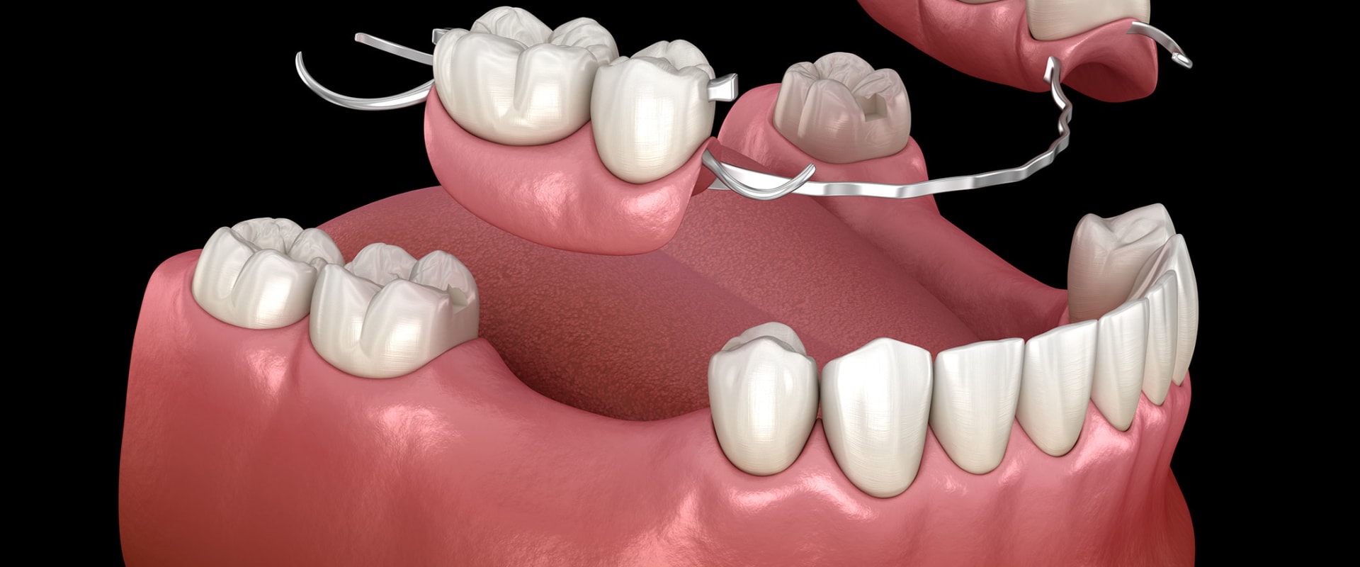 A Comprehensive Look into Types of Removable Dentures
