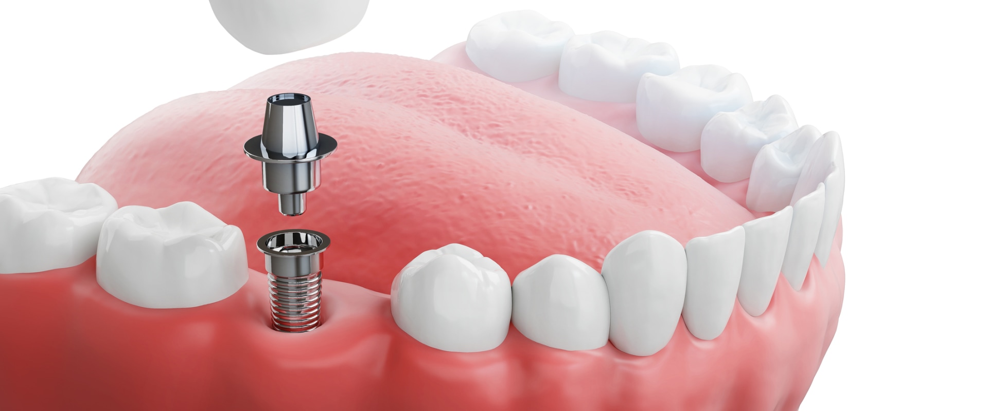 The Benefits of Zirconia Implants: A Comprehensive Guide to Replacing Missing Teeth