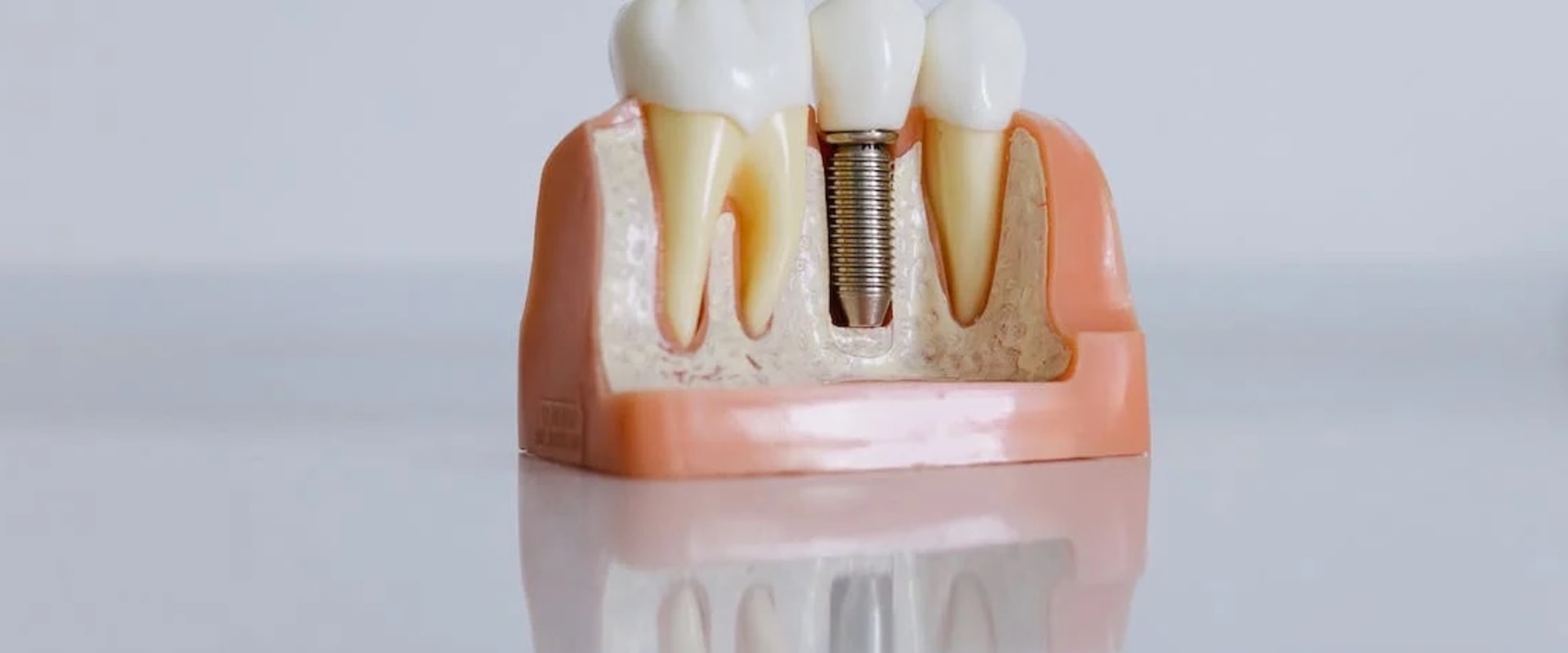 Insurance Coverage for Dental Implants: What You Need to Know