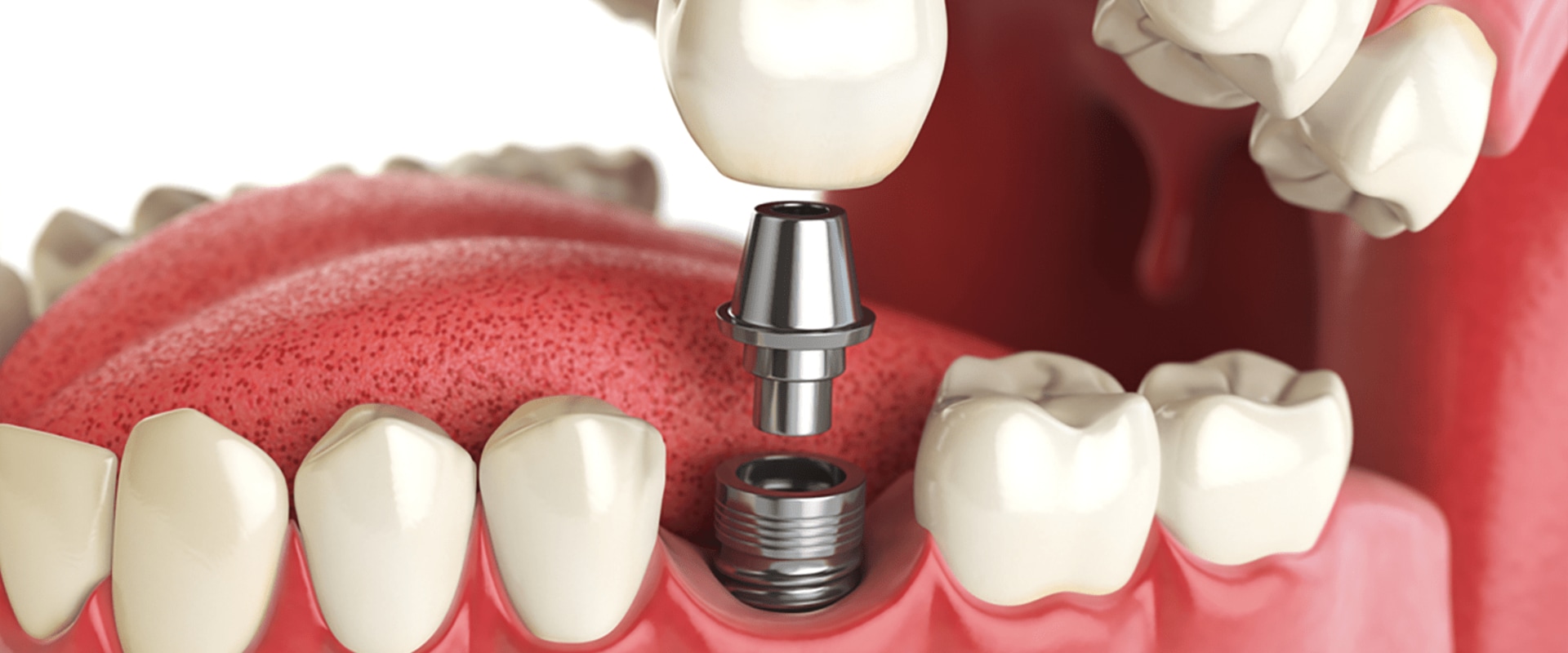 Understanding Dental Implants for Patients with Metal Allergies