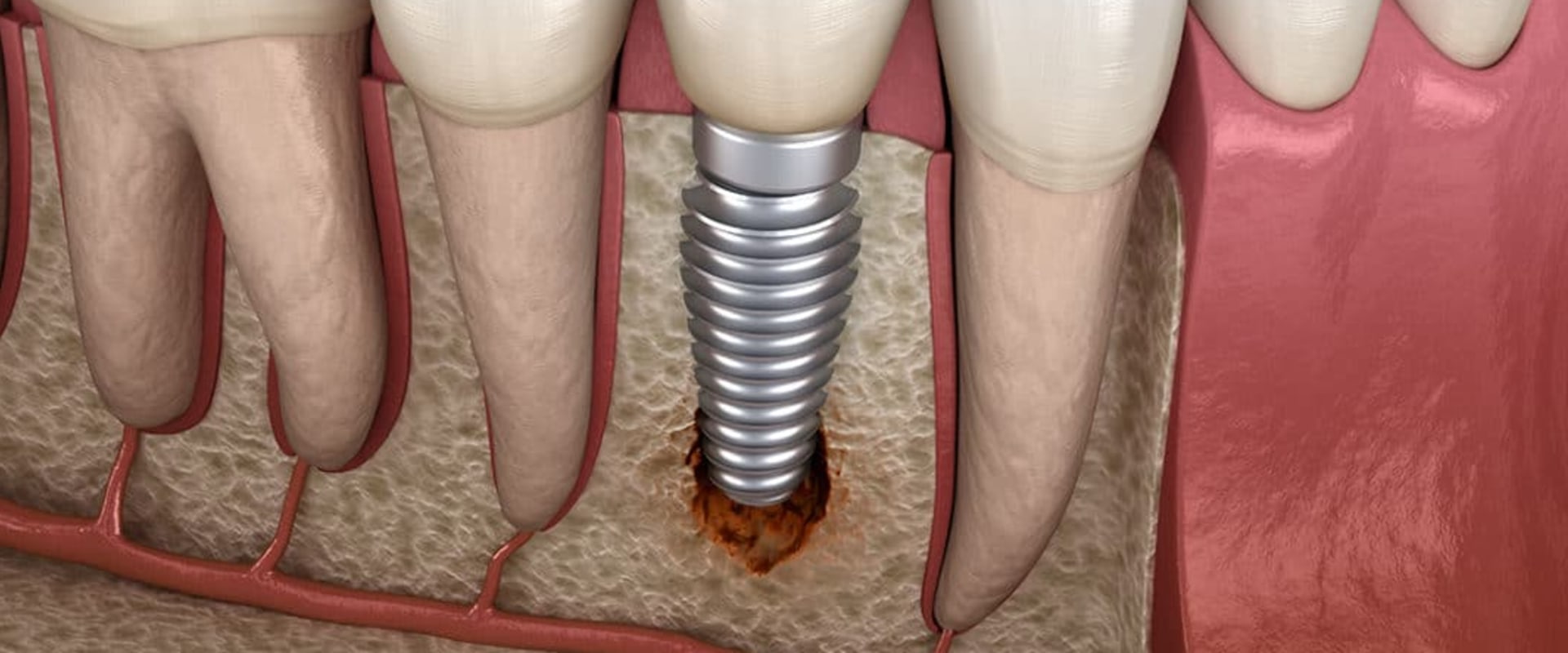 Possible Complications with Dental Implants