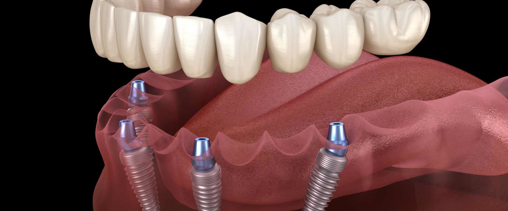 Exploring Additional Procedures and Treatments for Replacing Missing Teeth