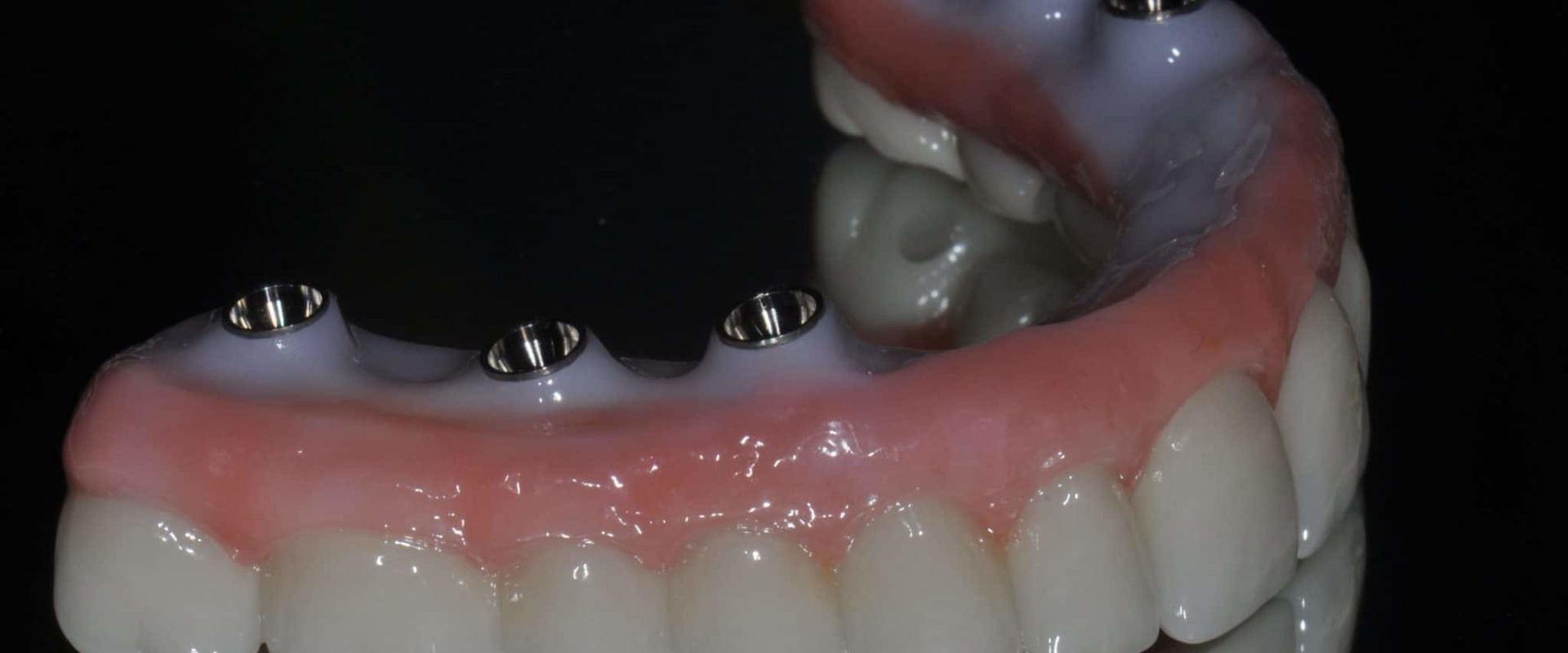 Zirconia vs Titanium: Which is the Best Material for Dental Implants?