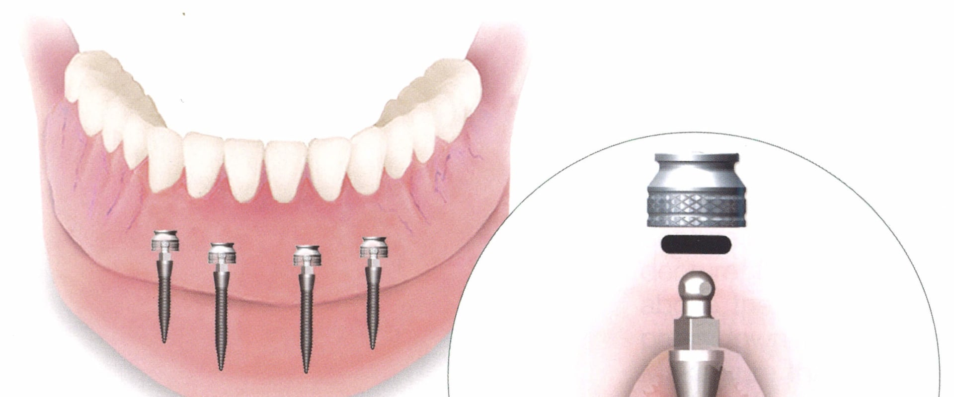 The Procedure for Placing Mini Dental Implants: A Comprehensive Guide