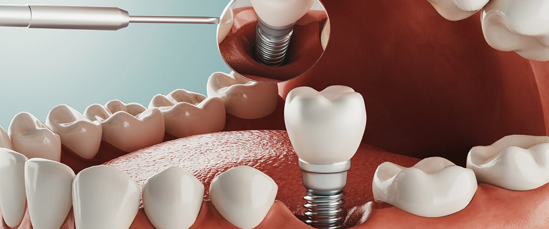 Exploring Alternative Options for Dental Implants