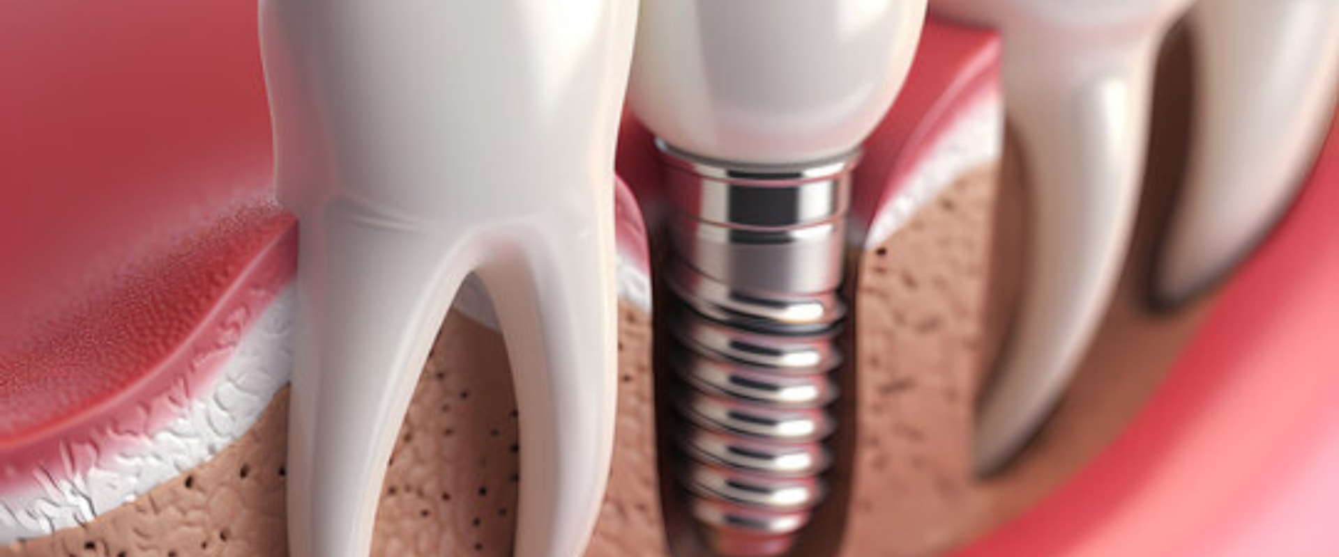 The Complete Guide to Understanding the Number of Implants Needed for Dental Procedures
