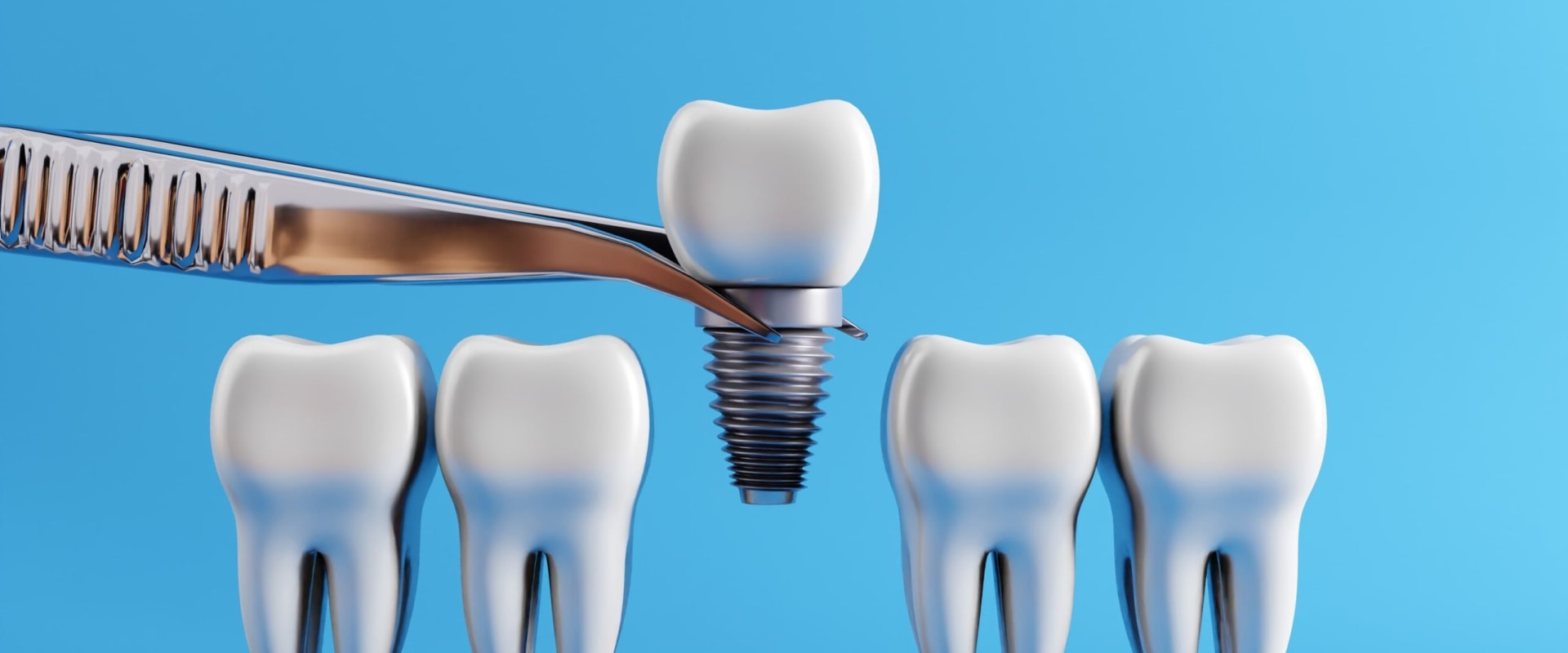 The Hidden Dangers of Nerve Damage from Dental Implants