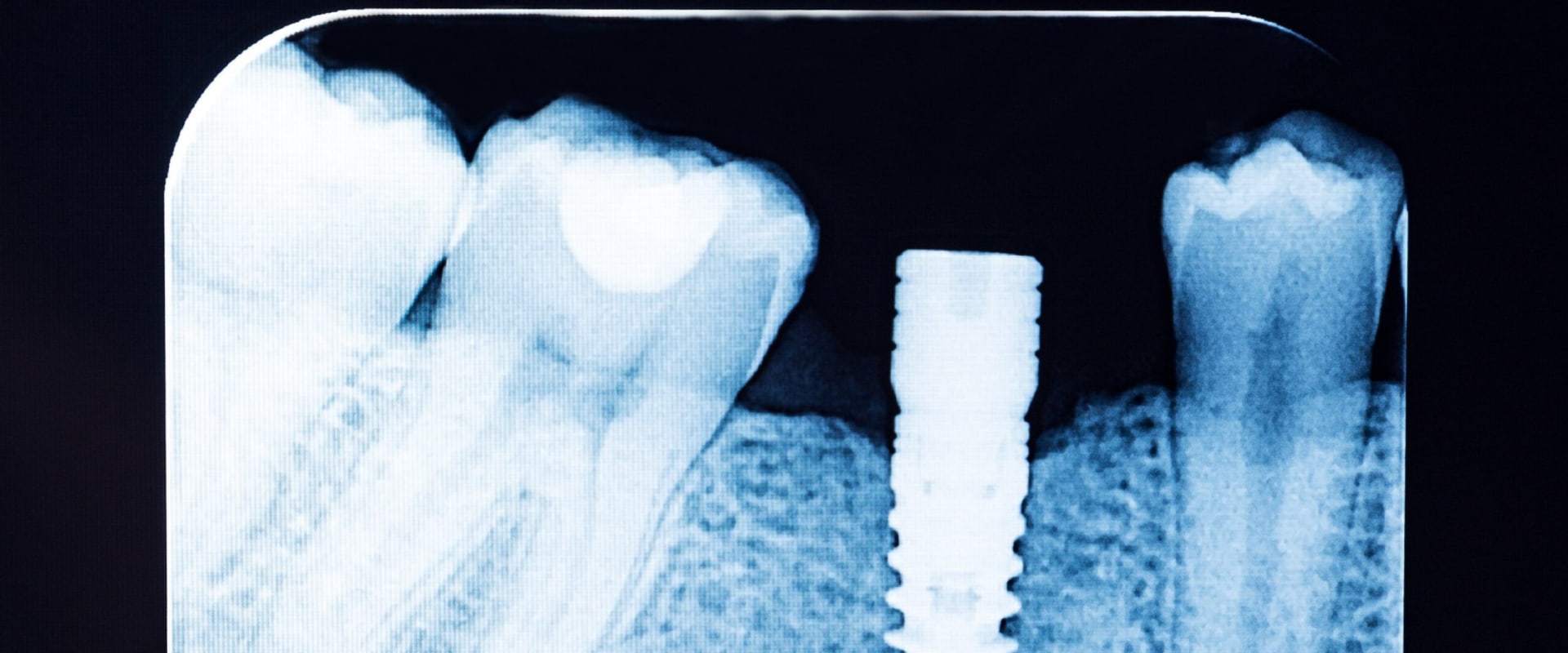Understanding X-rays and CT Scans for Dental Implant Planning