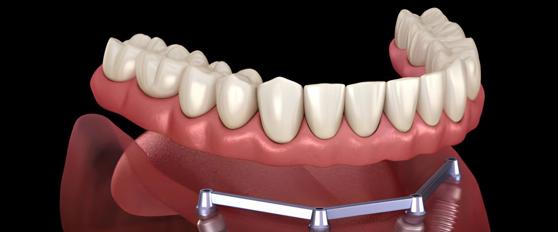 Cost and Financing Options for Dental Implants