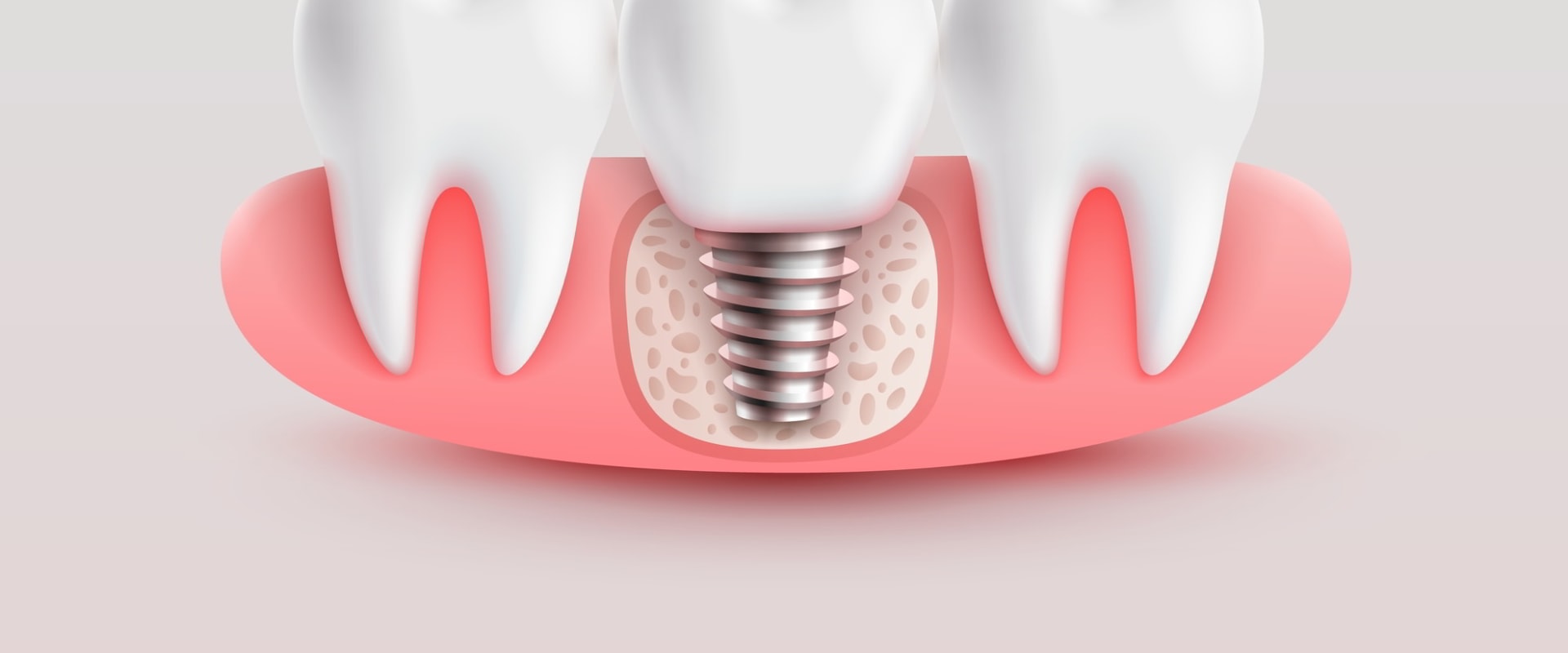 The Benefits of Subperiosteal Implants for Replacing Missing Teeth