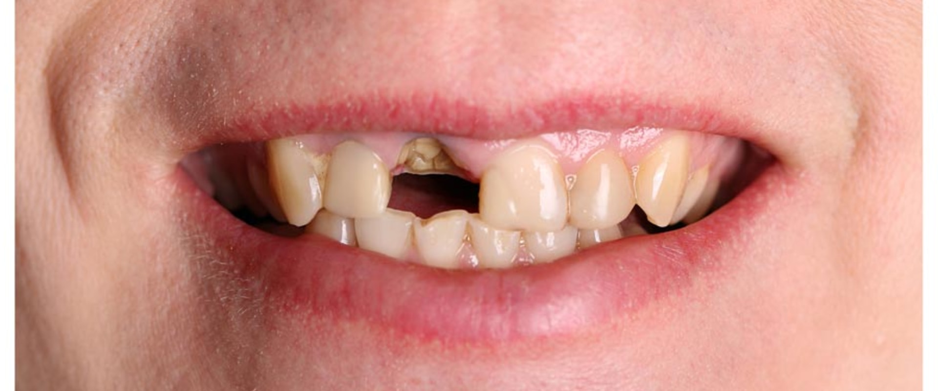 Payment Plans and Financing Options for Dental Implants