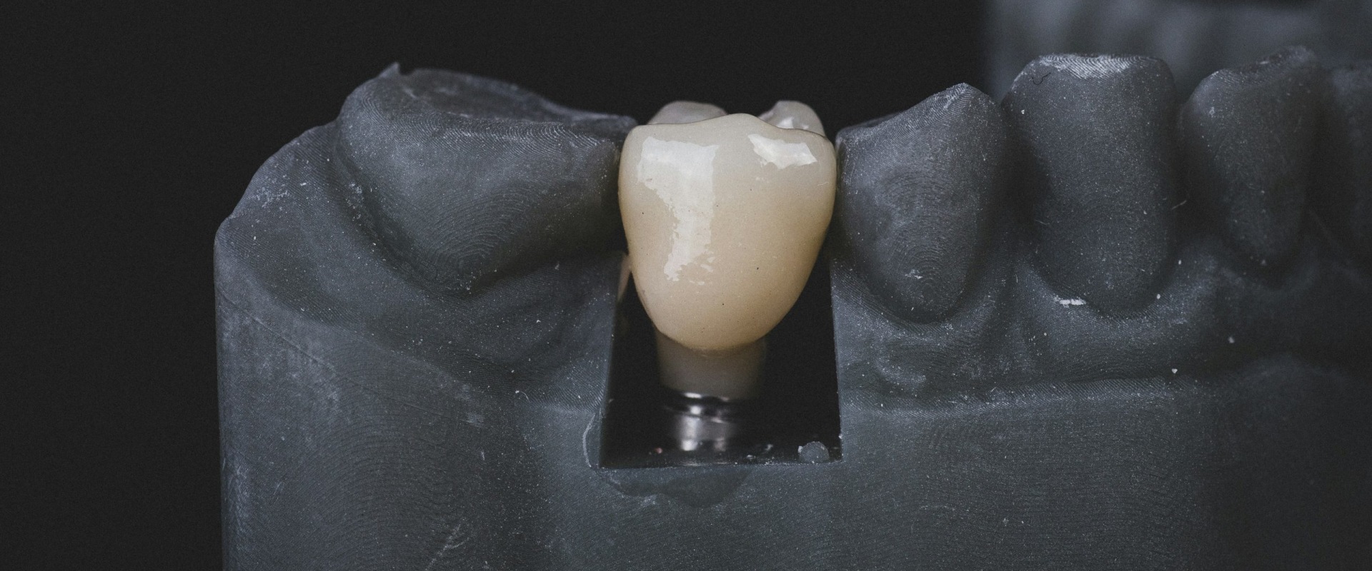 The Pros and Cons of Metal-free Ceramic Dental Implants