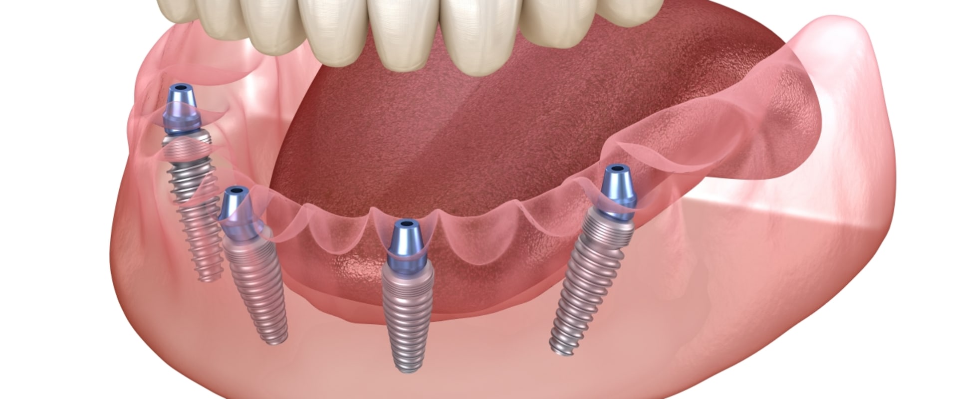 All-on-4 Implants: The Ultimate Solution for Missing Teeth