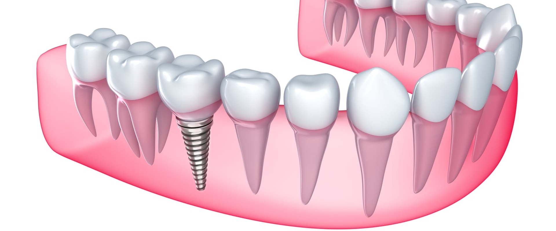 Understanding the Recovery and Healing Process for Dental Implants