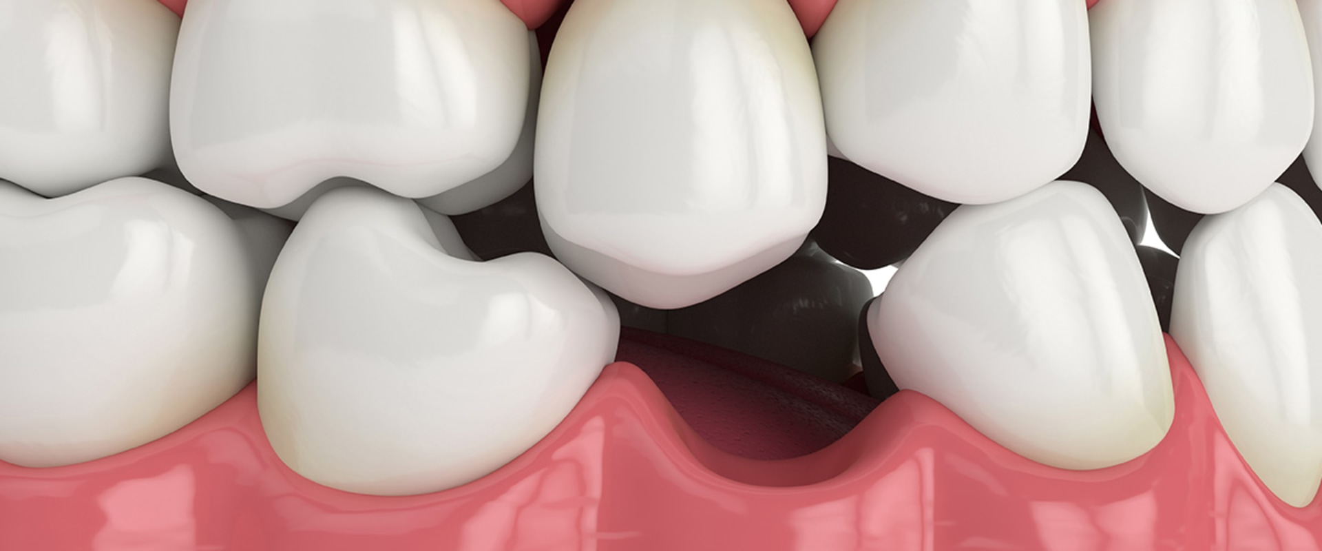 Preventing Implant Failure: Options and Solutions for Replacing Missing Teeth