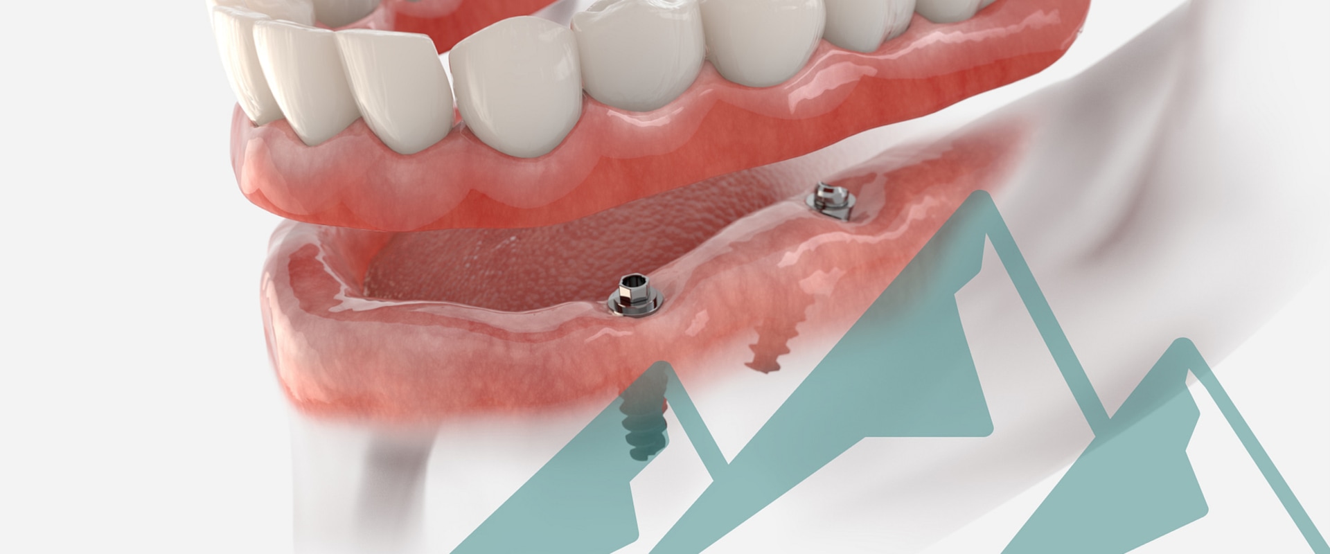 Procedure and Benefits of Modern Implants Compared to Traditional Implants