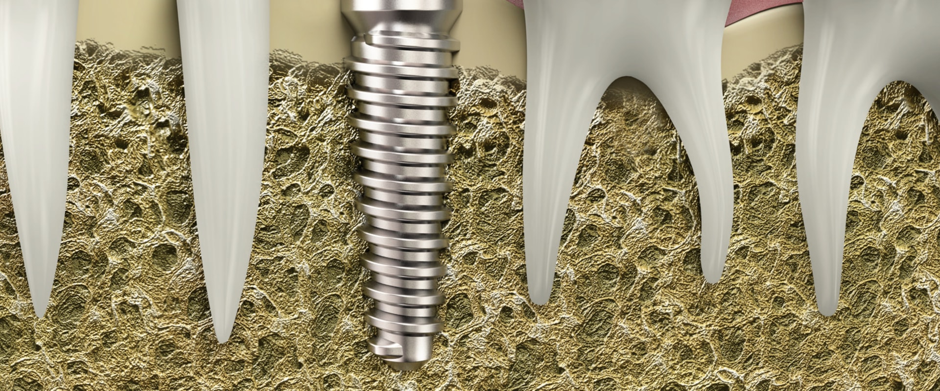 A Comprehensive Look at Dental Implant Suitability for Different Cases