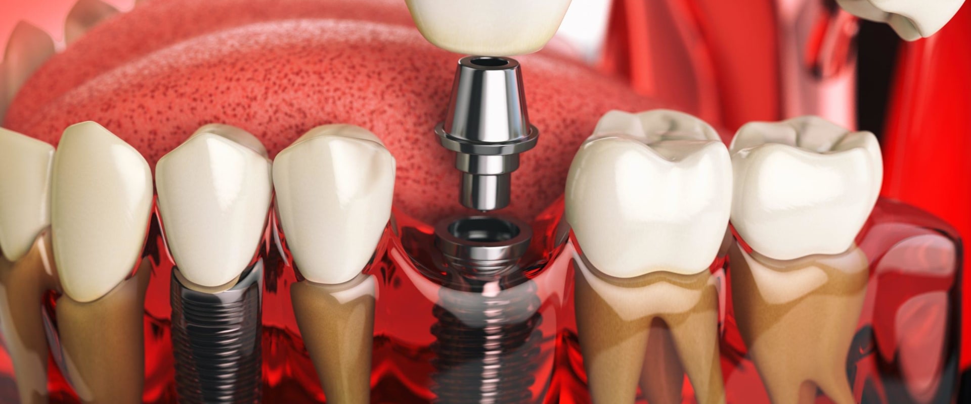 Exploring the Different Types of Dental Implant Materials