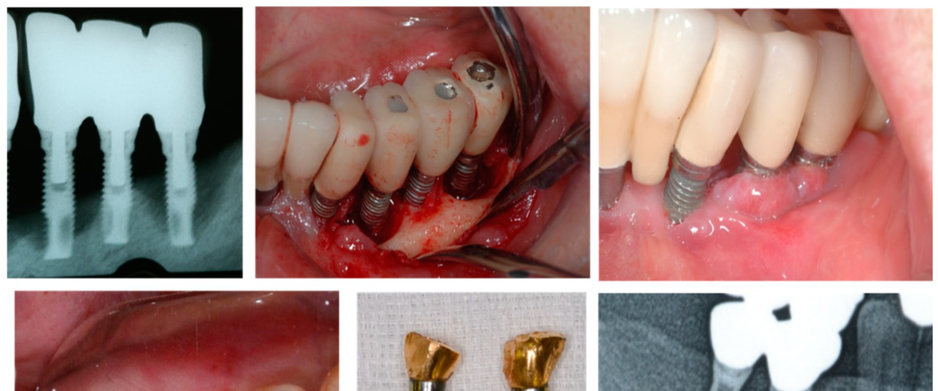 Causes of Implant Failure: Understanding the Risks