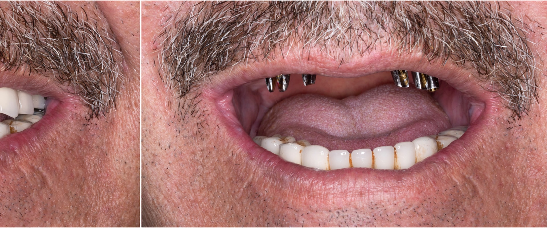 Pros and Cons of Dental Implants Compared to Other Options