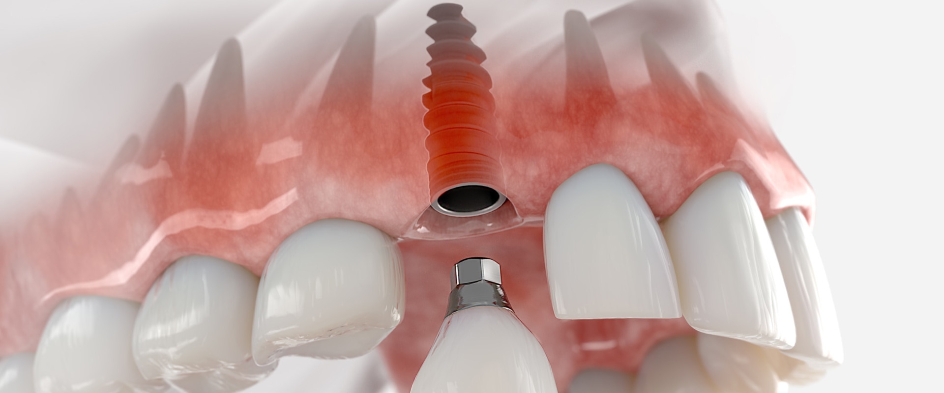 Dealing with Implant Failure: A Step-by-Step Guide