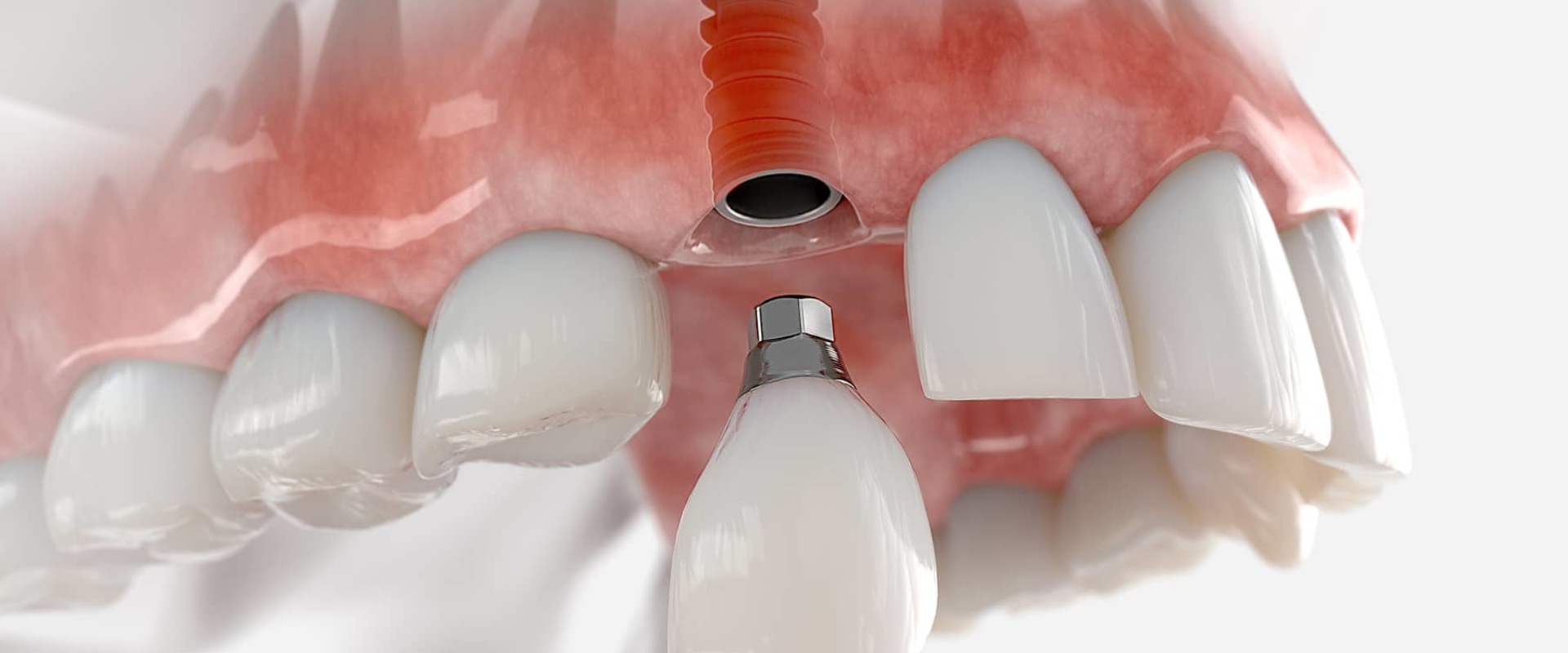 Placing the Final Crown on the Abutment: A Comprehensive Guide for Dental Implant Patients