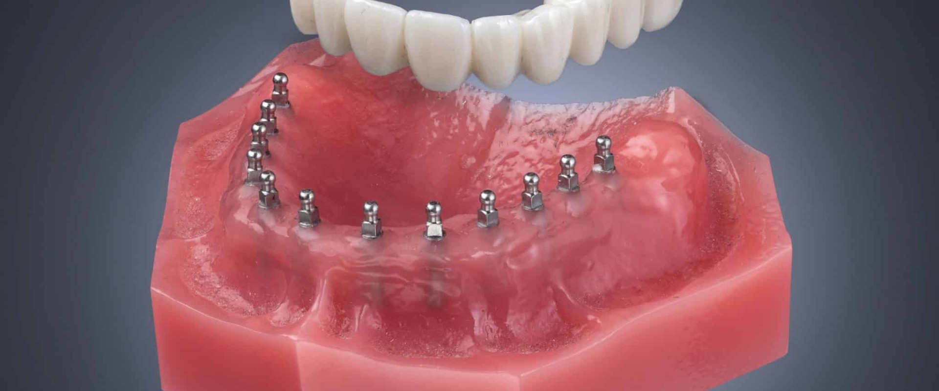 Exploring the Benefits of Mini Dental Implants