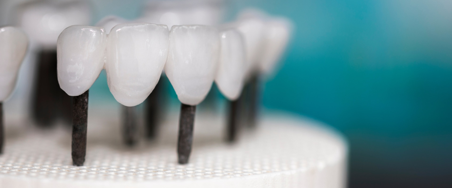 Potential Drawbacks of Zirconia Implants: What You Need to Know