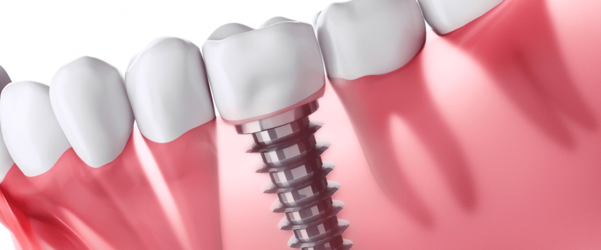 The Cost of Dental Implants in the US: What You Need to Know