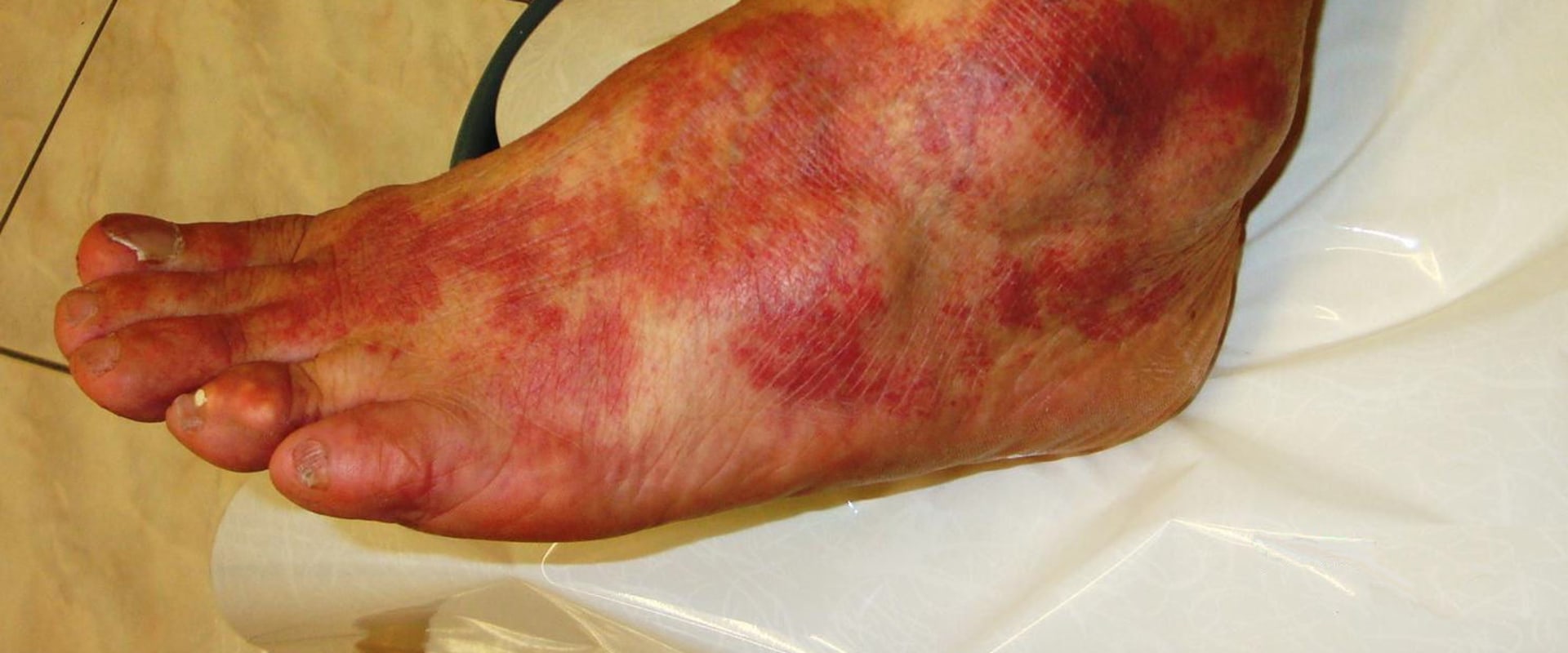 Causes and Symptoms of Infection or Inflammation
