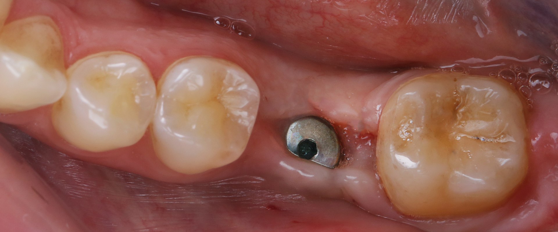 Surgical Procedure for Implant Placement: Everything You Need to Know