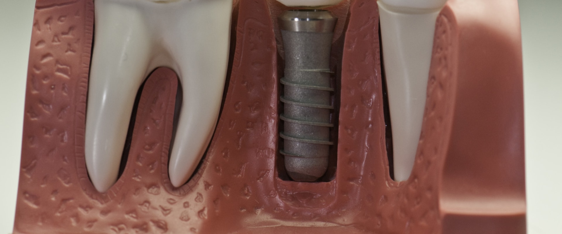 Preventing Infections After Implant Surgery: Everything You Need to Know