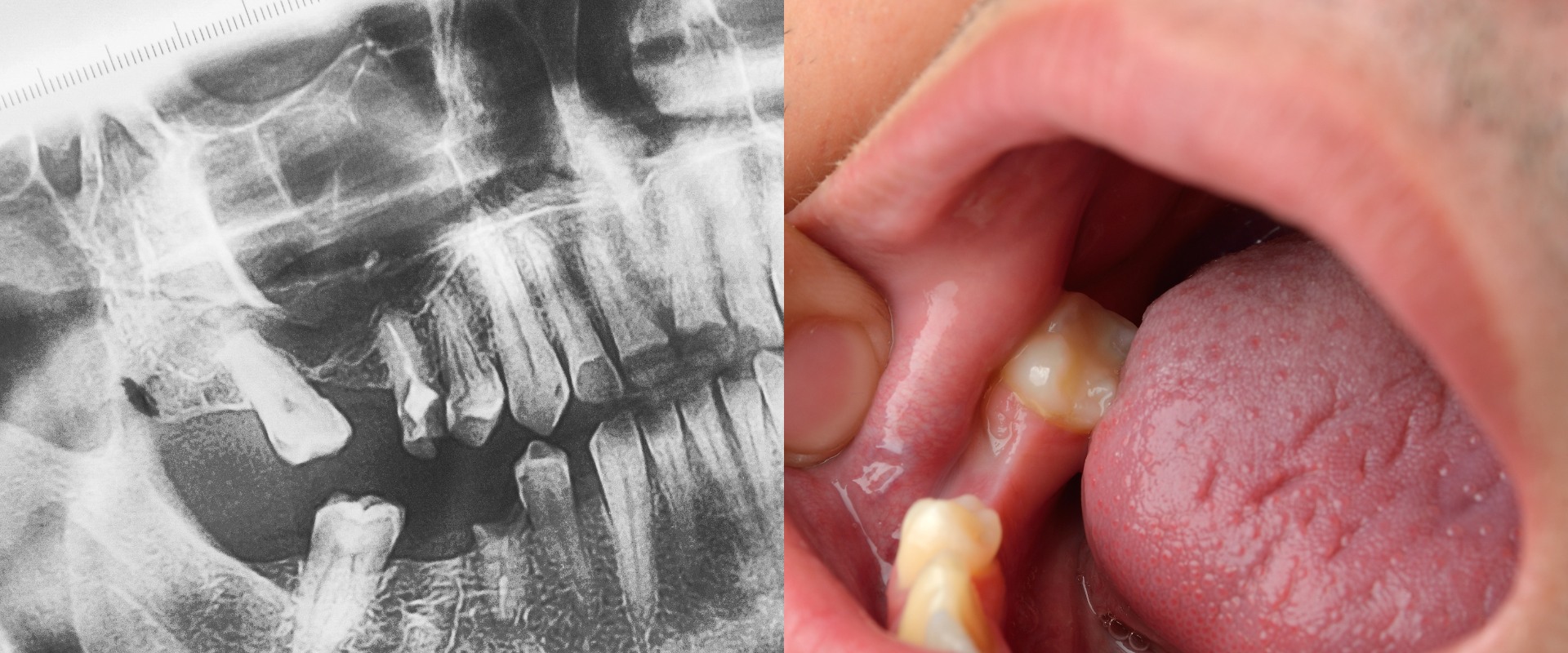 Cost of Implants in Europe: A Comprehensive Guide to Replacing Missing Teeth