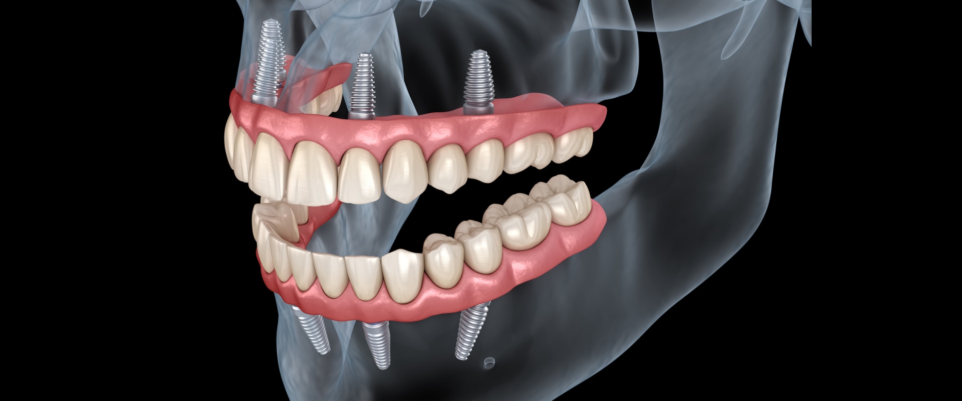 Creating a Treatment Plan for Dental Implants