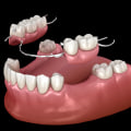 A Comprehensive Look into Types of Removable Dentures