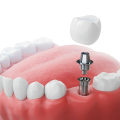 The Benefits of Zirconia Implants: A Comprehensive Guide to Replacing Missing Teeth
