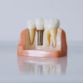 Insurance Coverage for Dental Implants: What You Need to Know