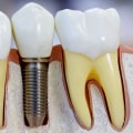 The Benefits of Titanium Implants for Replacing Missing Teeth
