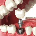Understanding Dental Implants for Patients with Metal Allergies