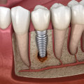 Possible Complications with Dental Implants