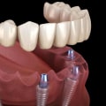 Exploring Additional Procedures and Treatments for Replacing Missing Teeth