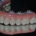 Zirconia vs Titanium: Which is the Best Material for Dental Implants?