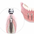 The Procedure for Placing Mini Dental Implants: A Comprehensive Guide