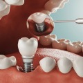 Exploring Alternative Options for Dental Implants