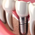 The Complete Guide to Understanding the Number of Implants Needed for Dental Procedures