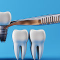 The Hidden Dangers of Nerve Damage from Dental Implants