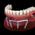 Cost and Financing Options for Dental Implants