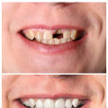 Payment Plans and Financing Options for Dental Implants